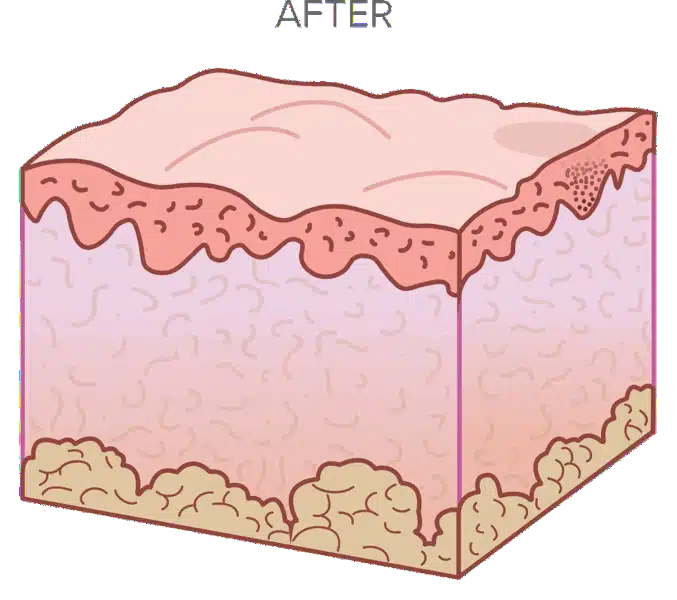 Illustration of a cross-section of skin with healed texture, showing layers and smooth surface marked as "After.