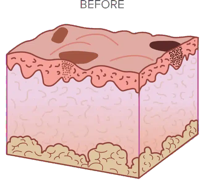 Illustration of a cross-section of skin labeled "Before," showing the surface and layers, with irregularities and spots on the upper layer.