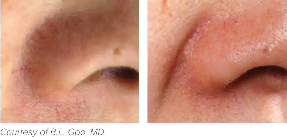 Close-up images of skin near the nose, showing redness and irritation.