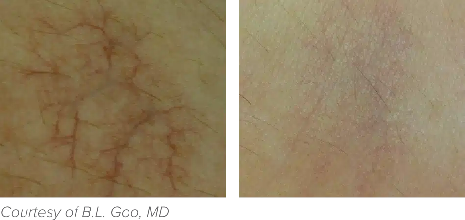 Side-by-side comparison of skin showing visible reduction in redness and dryness after treatment.