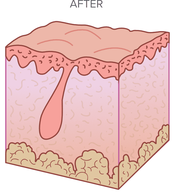 Illustration of a cross-section of healthy skin with a hair follicle, showing smooth epidermis and underlying layers.