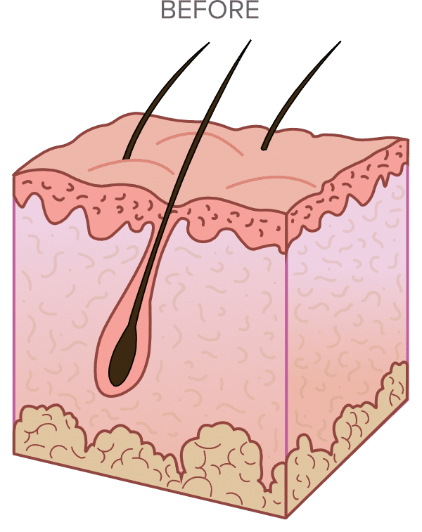 Cross-section illustration of human skin showing epidermis, dermis, and subcutaneous layer, with hair follicles extending from the surface to deeper layers.