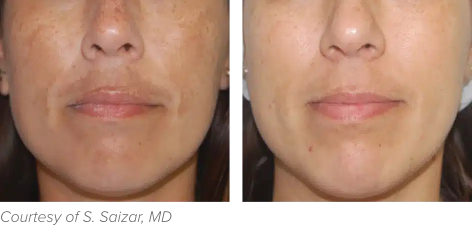 Side-by-side comparison of a woman's face showing skin improvement. The left image displays pigmentation; the right shows clearer skin.