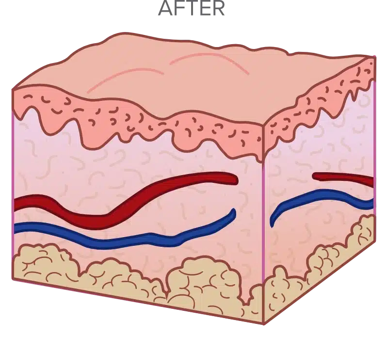 Illustration of a cross-section of human skin, showing multiple layers, with red and blue lines representing blood vessels.