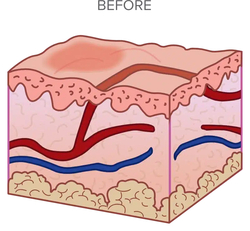 Illustration of a cross-section of human skin, showing layers with red and blue blood vessels and fatty tissue at the bottom.