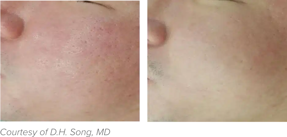 Before and after image of a person's cheek showing skin improvement from rough and red to smooth and clear.