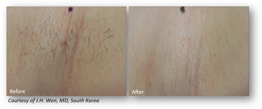 Before and after images of skin showing reduction in hair visibility.