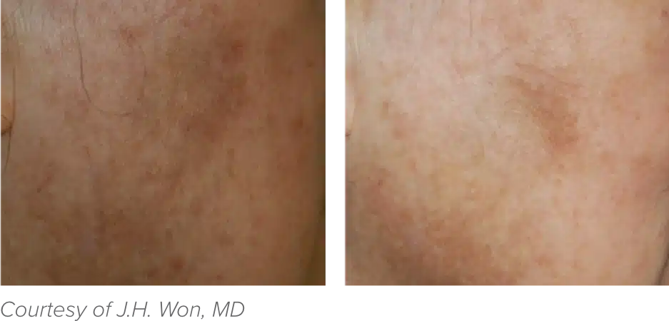 Side-by-side comparison of skin with dark spots on the left and slightly reduced spots on the right.