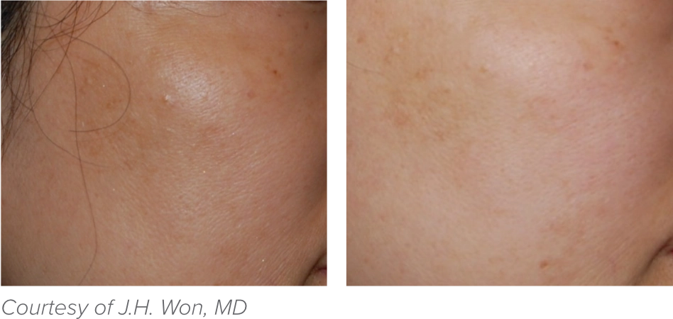 Comparison of a person's cheek before and after skincare treatment, showing reduction in blemishes and improved smoothness.