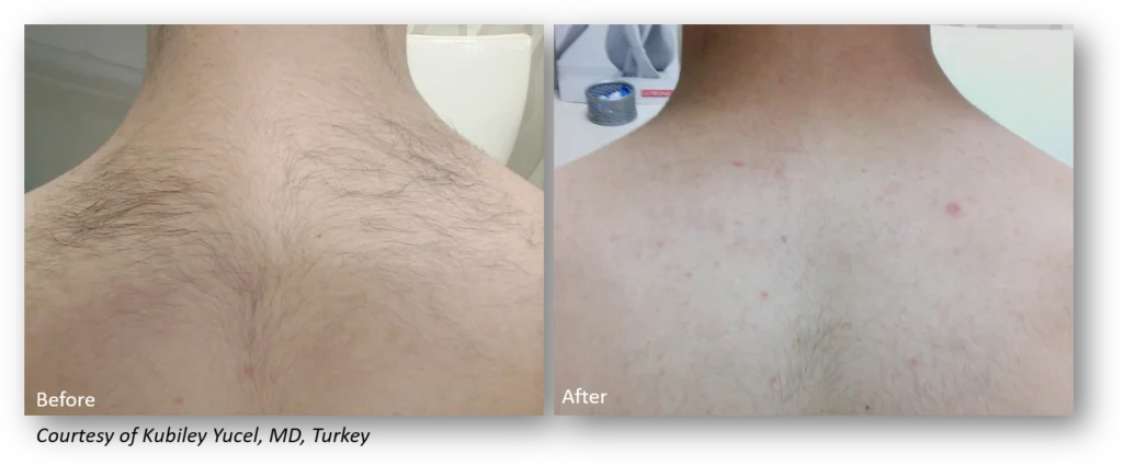 Side-by-side comparison of a person's upper back with visible hair before and after hair removal treatment, showing reduced hair in the after image.