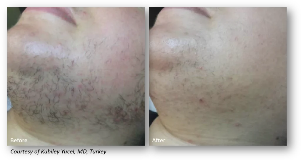 Side-by-side comparison of a person's chin showing reduction in hair and redness from the "before" image to the "after" image.