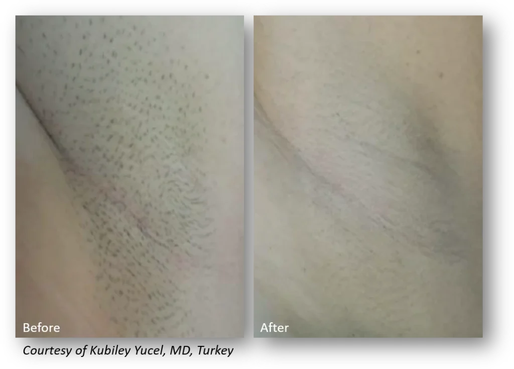 Side-by-side comparison showing underarm hair before and after treatment, with hair visibly reduced in the "after" image.